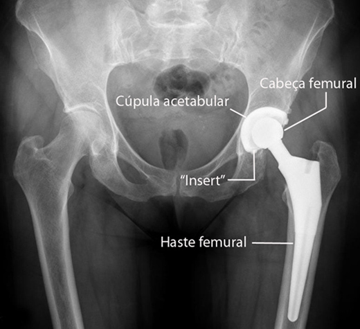 artroplastia total da anca 